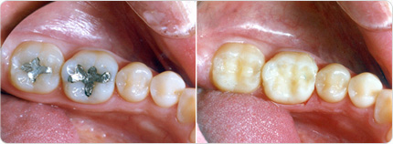 Remplacement des amalgames en composites - Facettes dentaires Paris  Esthetique du sourire Dr David Gutman