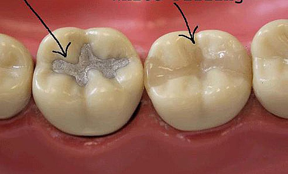 Mercure dentaire: Les plombages sont-ils un «poison» dans la bouche des  Français?